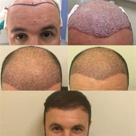Trapianto capelli in Turchia .